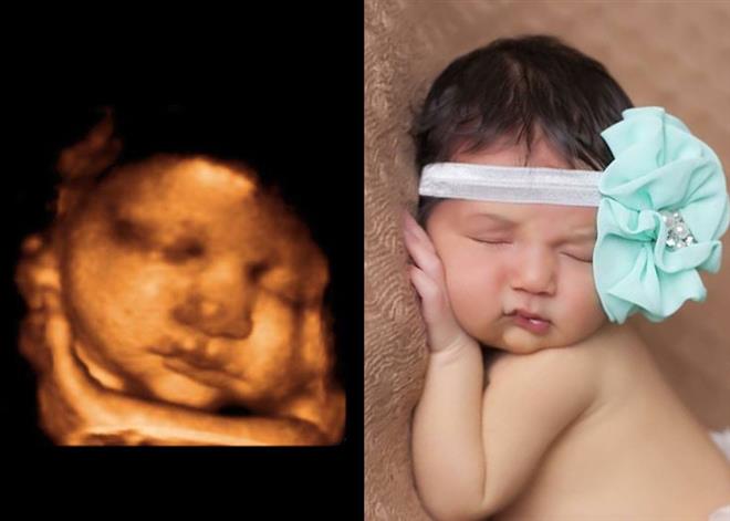 ultrasom do bebê - Pikuruxo