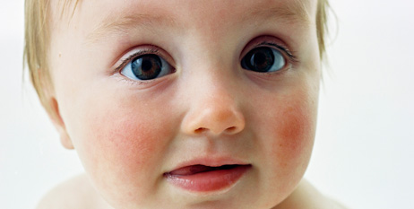 Irritações de pele e alergias no bebê | Pikuruxo